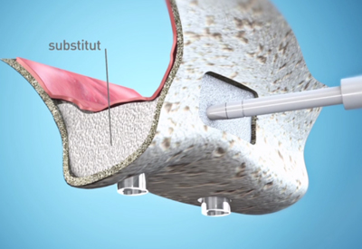Dr Francois Brutails - Dentiste - Vars - la Boixe - Sinus lift