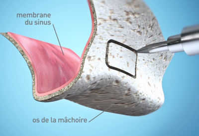 Dr Francois Brutails - Dentiste - Vars - la Boixe - sinus lift