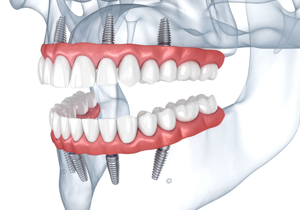 Dr Francois Brutails - Dentiste - Vars - la Boixe - All on 4