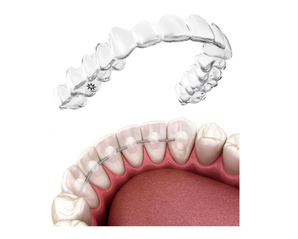 Dr Francois Brutails - Dentiste - Vars - la Boixe - Orthodontie invisible