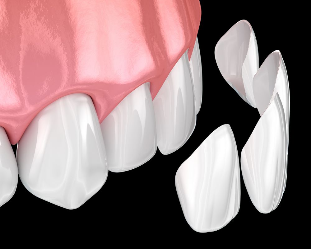 Dr Francois Brutails - Dentiste - Vars - la Boixe - facette dentaire