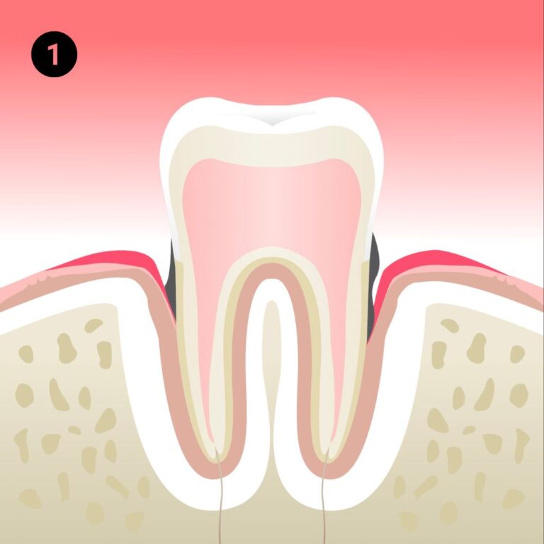 gingivite-cabinet-dentaire-idro-dr-benoit-lenfant-sene