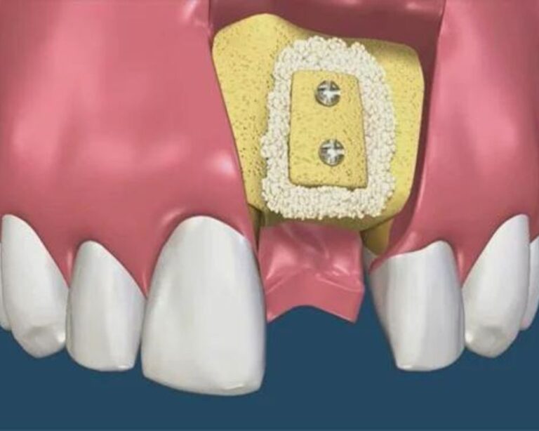 Dr Francois Brutails - Dentiste - Vars - la Boixe - Greffe osseuse