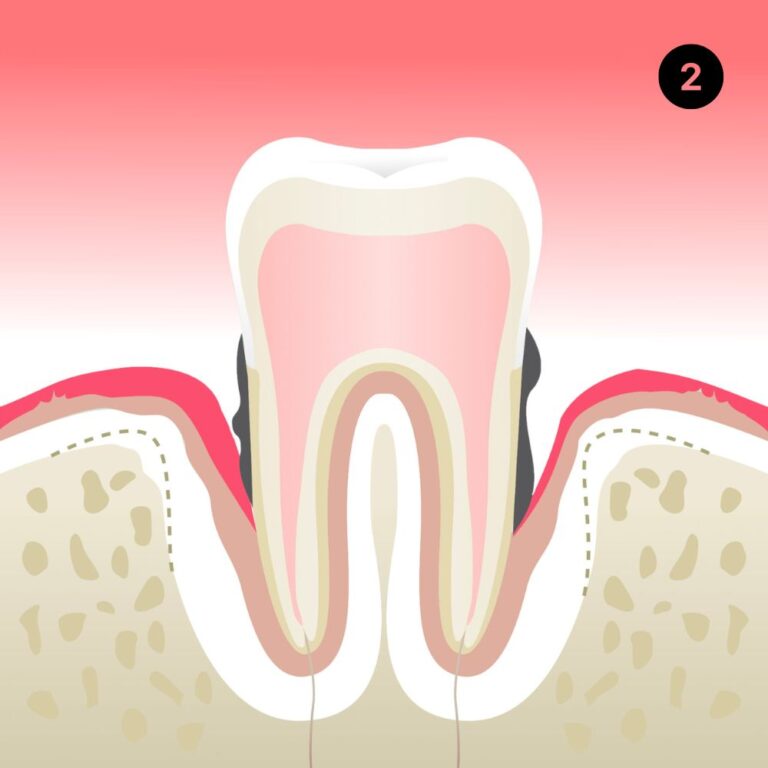 parodontite-cabinet-dentaire-idro-dr-benoit-lenafnt-sene