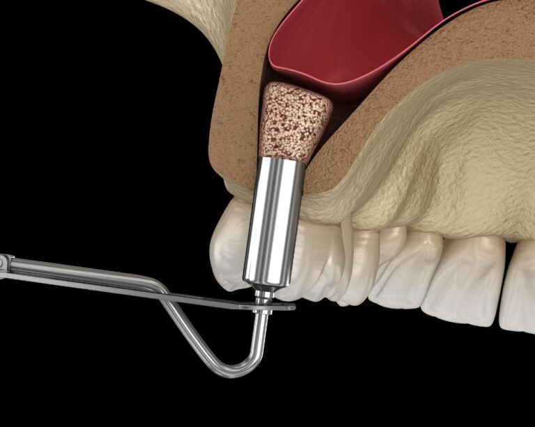 Dr Francois Brutails - Dentiste - Vars - la Boixe - sinus lift
