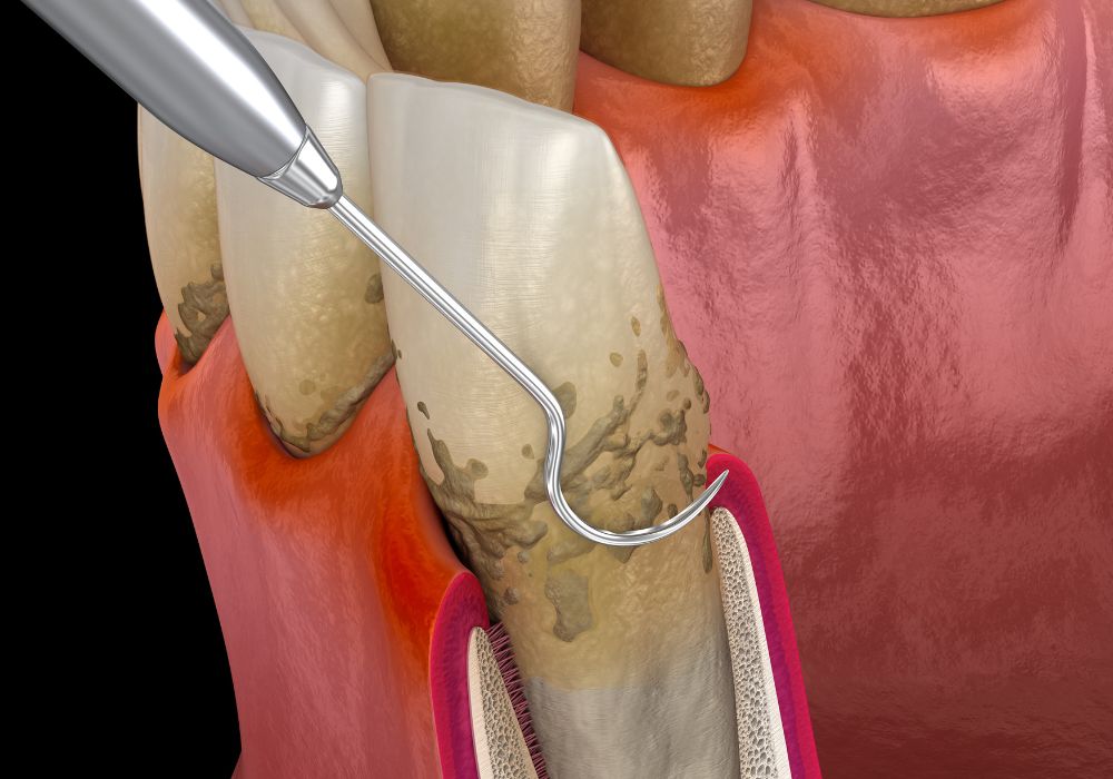 Dr Francois Brutails - Dentiste - Vars - la Boixe - Surfaçage radiculaire