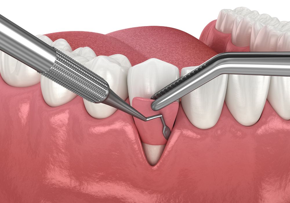 Dr Francois Brutails - Dentiste - Vars - la Boixe - Greffe gingivale